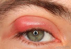 We did not find results for: What Are The Common Causes Of Eyelid Swelling With Pictures