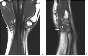 Image result for Pisiform Bone