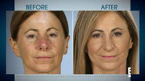 If you have skin cancer, it is important to know which type you have because it affects your treatment options and your outlook (prognosis). Cancer Patient Dissolved Chunk Of Her Nose Off With Alternative Remedy To Treat Skin Cancer