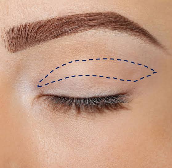 La blépharoplastie supérieure - Centre Médico Chirurgical Paris - Oeil et  Paupière