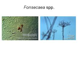 Aspergillus niger conidia de un cultivo de fonsecaea pedrosoi. Subcutaneous Mycoses These Are Caused By Fungi That