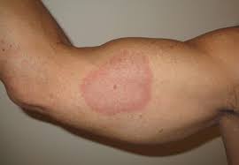Minor skin injuries and some drugs might trigger the condition. Granuloma Annulare Patch Type