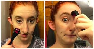 While home remedies like masks and massages are great ways to get rid of forehead wrinkles. I Tried To Use A Derma Roller And Here S What Happened Littlethings Com