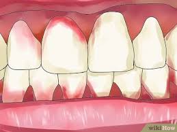 Periodontal disease is worsened gingivitis. 3 Ways To Reverse Dental Bone Loss Wikihow