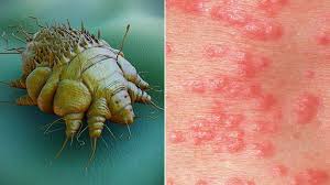It is common all over the world, and can affect anyone. What Is Scabies Symptoms Causes Diagnosis Treatment And Prevention Everyday Health
