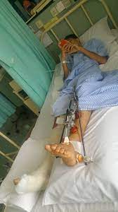 Patah kaki kambing patah kaki pemain bola patah kaki peribahasa patah pergelangan kaki kaki patah pasang besi kaki patah. Affiqazman On Twitter Tq Adi