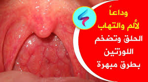 خبير يكشف طريقة مذهلة لعلاج ألم والتهاب الحلق واللوزتين للأبد علاج خلال Daily Workout Health Convenience Store Products