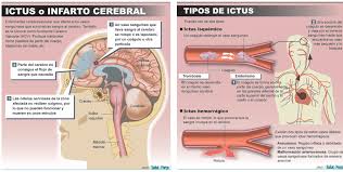 Se produce una pérdida de la función cerebral con la muerte de las células cerebrales. El Ictus Principal Causa De Muerte Salud Ediciones