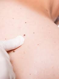 Anyone with a prolonged, unexplainable itch should consult either their primary. This Man S Skin Tag Turned Out To Be Skin Cancer Allure