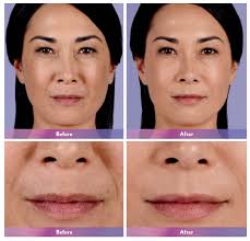 These and other questions are going to be answered in this article. Juvederm In Indianapolis Laser And Skin Surgery Center Of Indiana