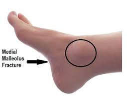 Ankle fractures in neuropathic and diabetic patients. Ankle Undisplaced Medial Malleolus Fracture Virtual Fracture Clinic