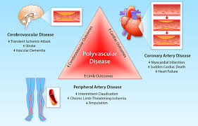 Image result for Edinburgh Claudication Questionnaire