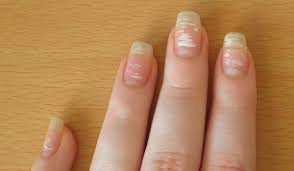 Des taches blanches apparaissent parfois sur l'ongle et ce phénomène est connu sous le nom de leuconychie, et il en existe de nombreux types. Pourquoi Y A T Il Des Taches Blanches Sur Les Doigts Des Taches Blanches Sur Les Ongles Pourquoi Est Ce Dangereux Traitement Ou Comment Se Debarrasser De La Leuconychie