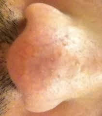 Typically, it doesn't appear until middle age or older. Treatment For Bumps Scars On Nose Images Please Help Hypertrophic Raised Scars Acne Org