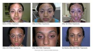 XTRAC® Laser Treatments for Psoriasis, Vitiligo, and Atopic Dermatitis