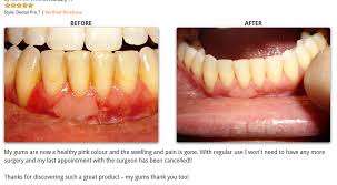 Once the gum tissue has receded from the teeth, it cannot grow back. Can Receding Gums Be Reversed Care Com