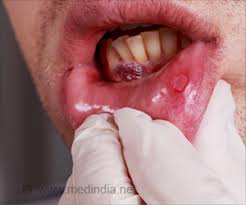 Mouth cancer symptoms in hindi: Tracheal Cancer Cancer Of The Windpipe Causes Symptoms Diagnosis And Treatment