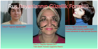Unluler Ve Suluk Tedavisi Dr Mehmet Ozkent