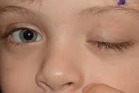 Image result for Pupillary Paralysis