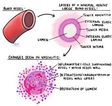 Image result for Vasculitis