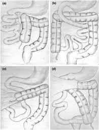 Image result for Intestinal Malrotation