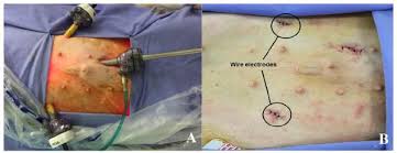 Scielo Brasil Technique For Implanting Intramuscular Electrodes In The Diaphragm By Videolaparoscopy In Pigs Technique For Implanting Intramuscular Electrodes In The Diaphragm By Videolaparoscopy In Pigs