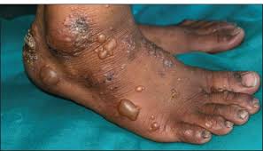 Image result for pompholyx soles of feet