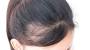 Early Stage Female Pattern Baldness