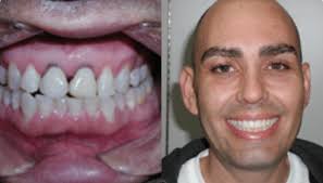 Smile Gallery: Transformations at Big Smile Dental Chicago