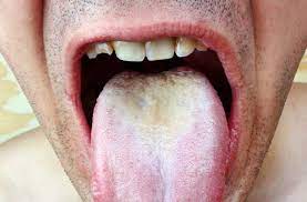 About 8 out of 10 of all skin cancers are basal cell carcinomas (also called basal cell cancers). Thrush The White Stuff Growing In Your Mouth And How To Get Rid Of It Health Essentials From Cleveland Clinic