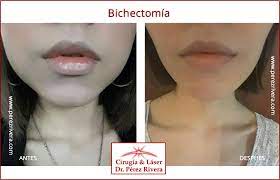 Tratamiento realizado vale la pena. Bichectomia Cirugia Reductiva De Mejillas Como Bajar Los Cachetes Adelgazamiento De Rostro Adelgazamiento De Cara Reduccion De Mejillas Reducir Los Cachetes Reduccion De Cachetes