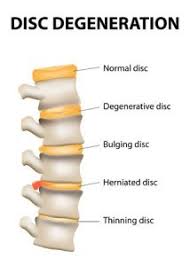 Stem Cell Therapies For Neck And Back Pain Sinw Canada