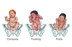 Image result for Breech Delivery