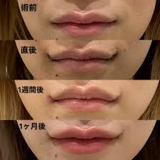 唇切開症例 | たれ目・眼瞼下垂専門 医療法人社団エタプリ会 エターナル美容クリニック