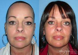 The Main Differences Between Eyelid Surgery (Blepharoplasty) vs. Brow Lift