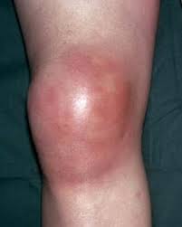 Image result for Septic Joint