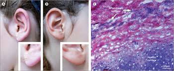 Image result for Relapsing Polychondritis