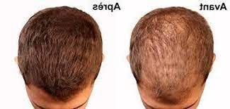 Maybe you would like to learn more about one of these? Acheter Comment Eviter La Calvitie Pas Cher Jr Prestations
