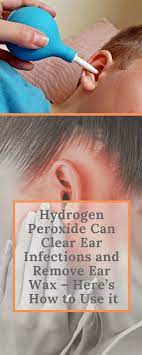Hydrogen Peroxide Can Clear Ear Infections And Remove Ear Wax Here S How To Use It Ear Cleaning Wax Ear Wax Clean Ear Wax Out