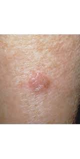 It may keep growing weeks after your skin heals. Signs Of Skin Cancer This Skin Check Can Save Your Life Glamour