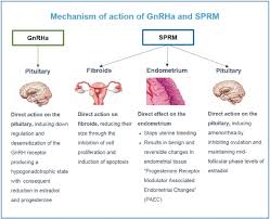 The Current Place Of Medical Therapy In Uterine Fibroid