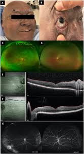 Colloidal silver toxicity with absence of choroidal signal