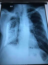 Right Sided Volume Loss Feature Trachea On Same Side Right Diaphragm Elevated Opposite Lung Hyperinflation And Herniated To Right Pleural Calcification