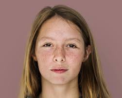 Image result for Freckled skin