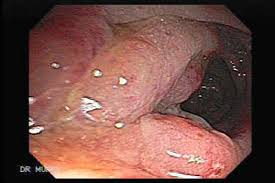 (diverticulitis, appendicitis, colon cancer, chronic inflammatory disease of the intestine) should be sought for any. Diverticular Disease The Gastrointestinalatlas Gastrointestinalatlas Com