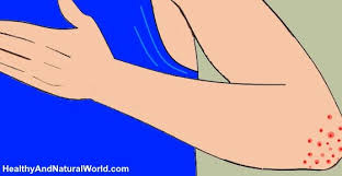 Bumps On Elbows Causes Effective Treatments And When To See A Doctor Elbow Rash Rash Treatment Skin Bumps