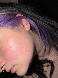 What causes itchy dry face bumps?