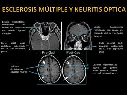 En la esclerosis múltiple la resonancia magnética nos sirve para el diagnóstico y para el seguimiento de la enfermedad. Como Llegar Al Diagnostico De La Esclerosis Multiple Blog Esclerosis Multiple Susosantiago