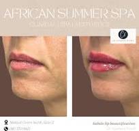 💋 Hyamax® Lips – Beauty in Every Smile Hyamax® Lips is ...