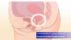 Op dit moment word ik daar niet beter van. Baarmoederhalskanker Startpagina Baarmoederhalskanker Info